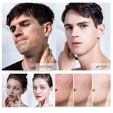 Herb tea tree Anti Acne Whitening Oil control soap for Unisex - Glam & Curious