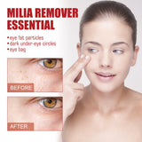 Milia Removal Eye Serum Dark Circles Fade fine lines Lifting Eye Serum - Glam & Curious
