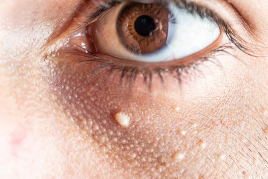 What Causes Milia? How to Treat the Little White Bumps