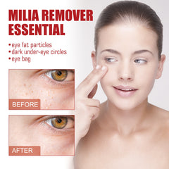 Milia Removal Essential Eye Serum Get rid of particles around the eyes, Fade dark circles Firming Fade fine lines Lifting Eye Serum