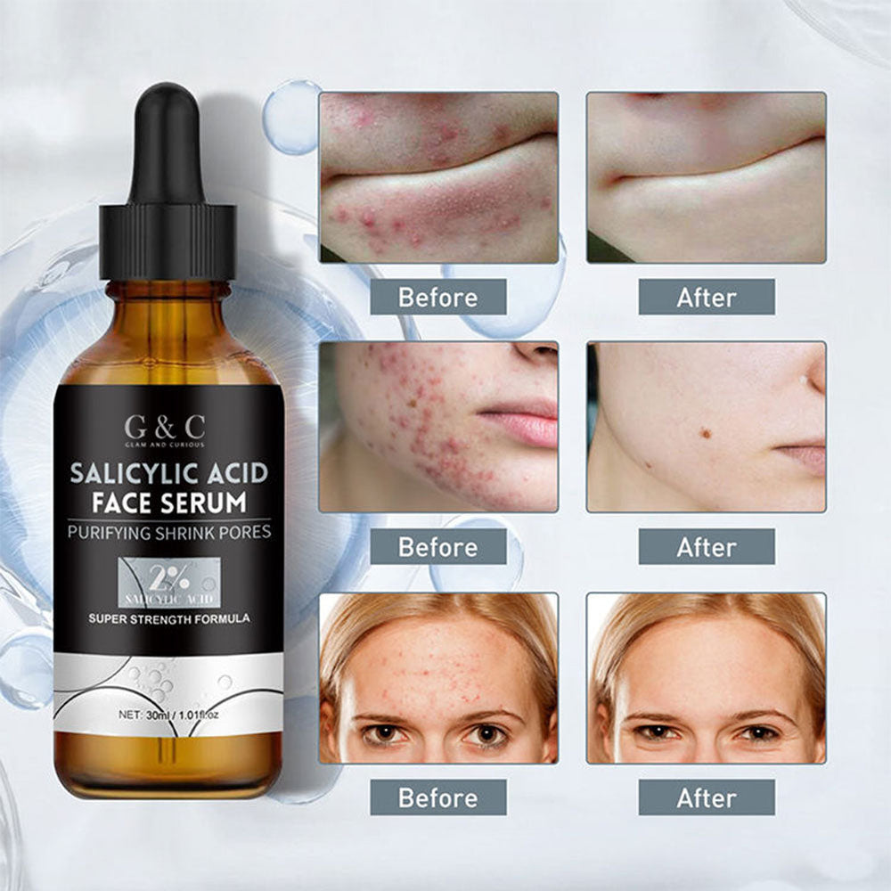 Glam & Curious salicylic acid face wash and anti-acne serum bundle for oil control, pimple removal, and dark spot repair.