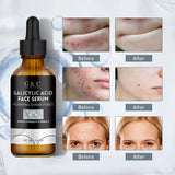 Salicylic Acid Acne Serum – Dark Spot Repair, Oil Control & Moisturizing