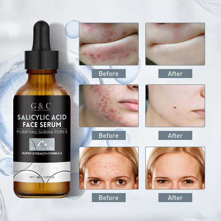 Salicylic Acid Serum for Anti Acne Face Serum, Acne Treatment, Repair dark Spots Scar Moisturizing, Oil Control Shrink