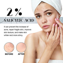 Salicylic Acid Serum for Anti Acne Face Serum, Acne Treatment, Repair dark Spots Scar Moisturizing, Oil Control Shrink